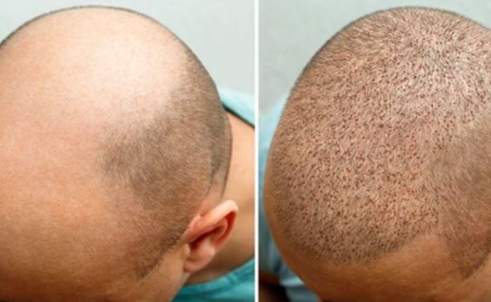 Magkano ang Hair Transplant