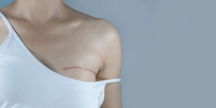 Magkano ang Mastectomy