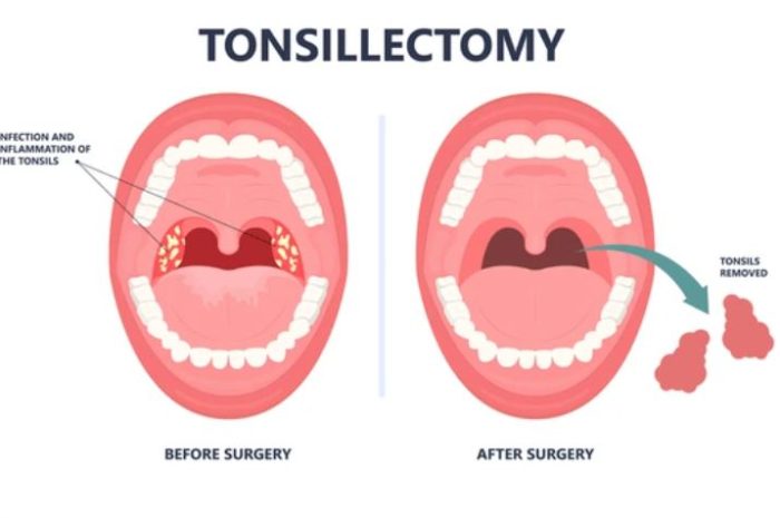 Magkano ang Tonsillectomy