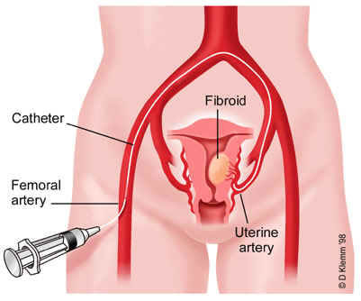 Magkano ang Embolization sa Pilipinas