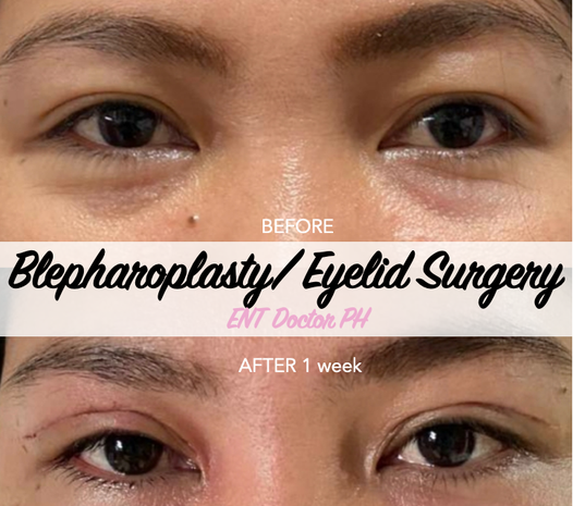 Magkano ang eyelid surgery sa Pilipinas?