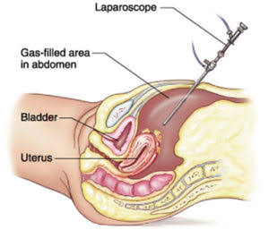 Magkano ang Laparoscopy sa Pilipinas? Gastos, Mga Salik na Nakaaapekto sa Presyo, at Mga Dapat Malaman